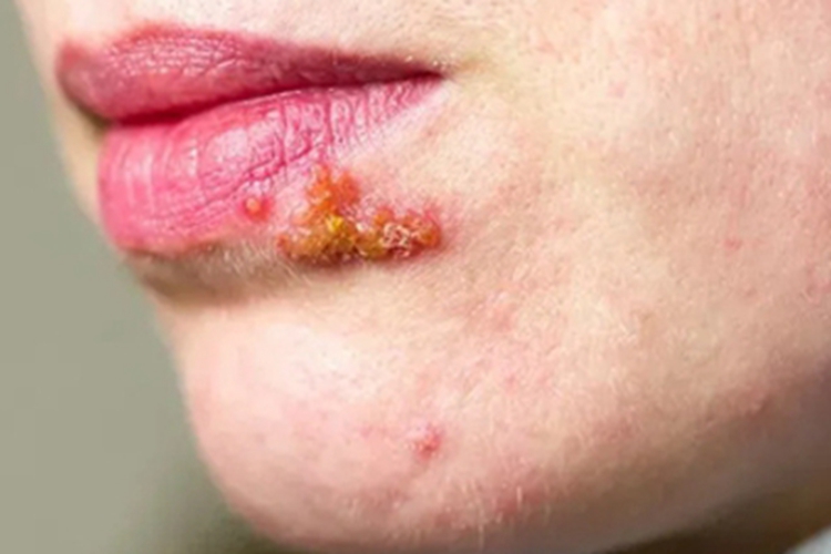 唇疱疹嘴边长水疱烂了结痂图
