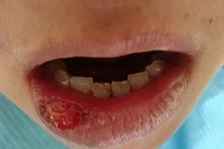 梅毒性唇下疳嘴唇结痂图