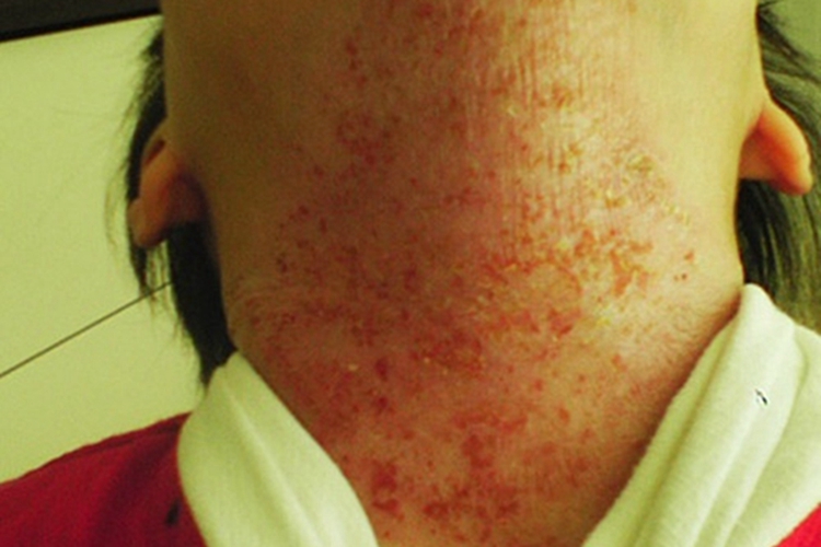 儿童期特应性皮炎前颈溃疡图