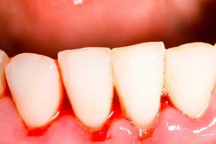 白血病牙龈出血图