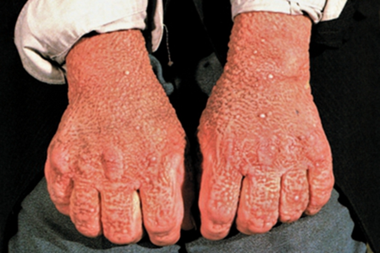 黏蛋白病手背丘疹图