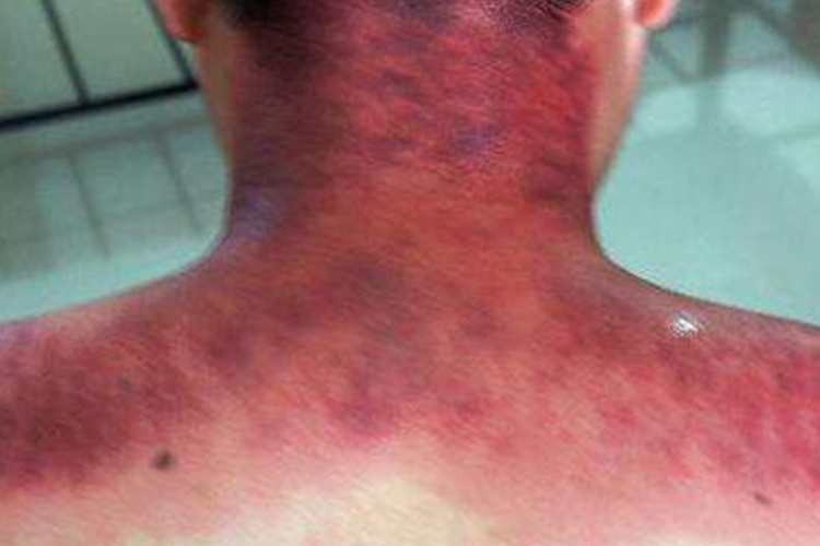 重度痧象黑紫色疙瘩图