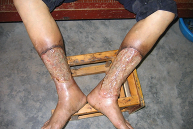 臁疮双侧小腿溃烂化脓图