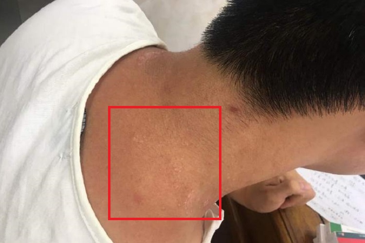 硬化萎缩性苔藓后颈症状图