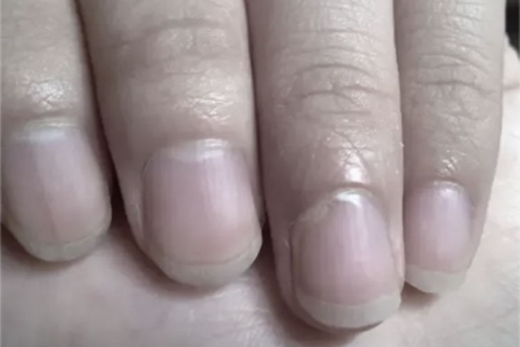 缺铁性贫血指甲发白图