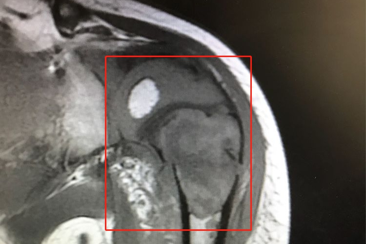 肱骨近端干骺端内骨肉瘤影像图 肱骨近端干骺端内骨肉瘤影像图