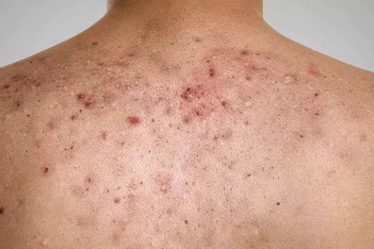 男人后背痤疮图