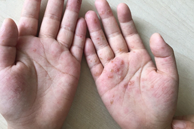 汗疱疹手掌水疱图