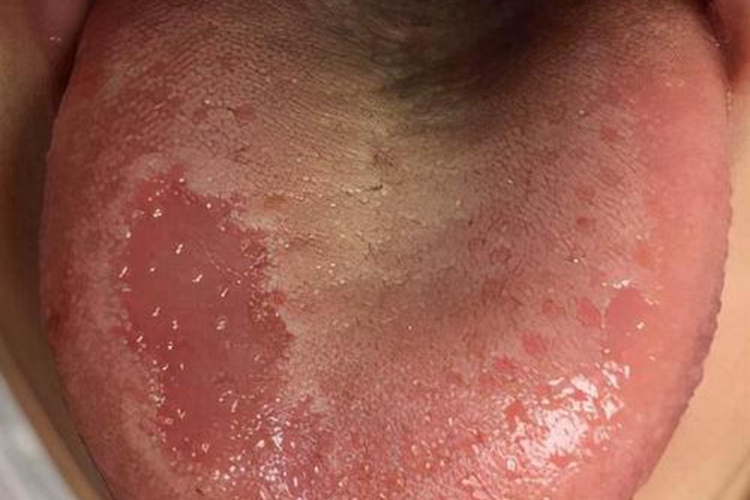 花剥苔图 花剥苔图