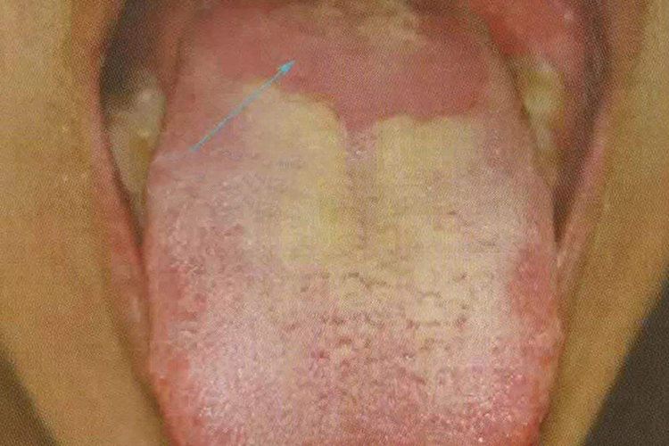 根剥苔图 根剥苔图