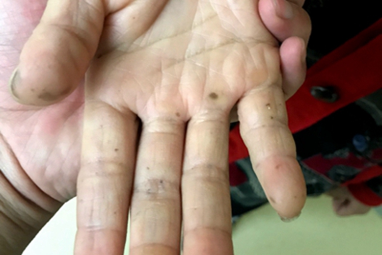 色素沉着息肉综合征手指症状图 色素沉着息肉综合征手指症状图