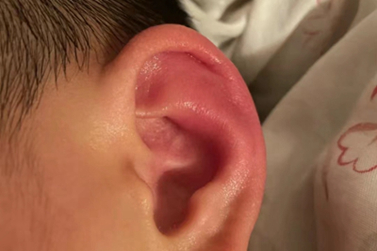 冻疮耳廓红肿图 冻疮耳廓红肿图