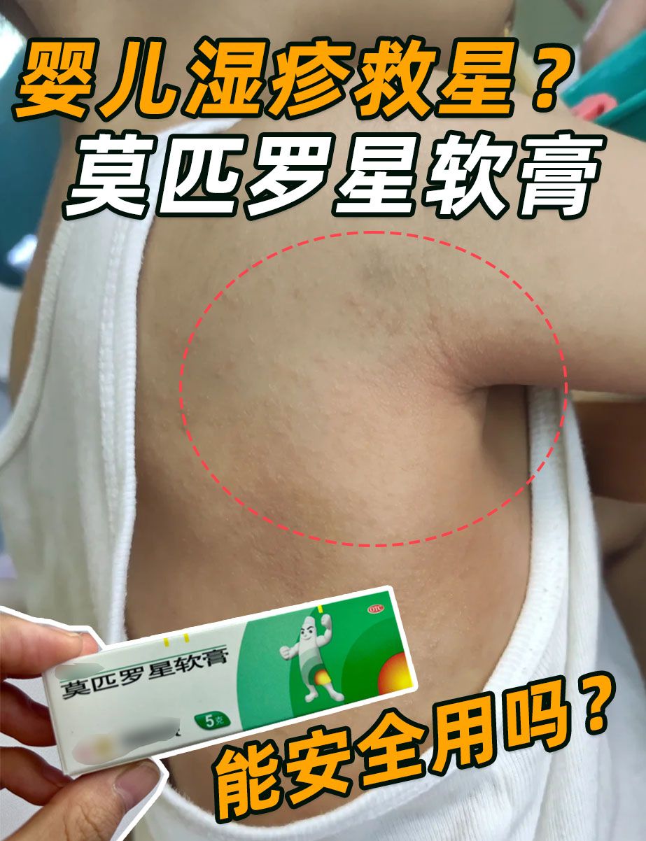婴儿湿疹救星？莫匹罗星软膏能安全用吗？