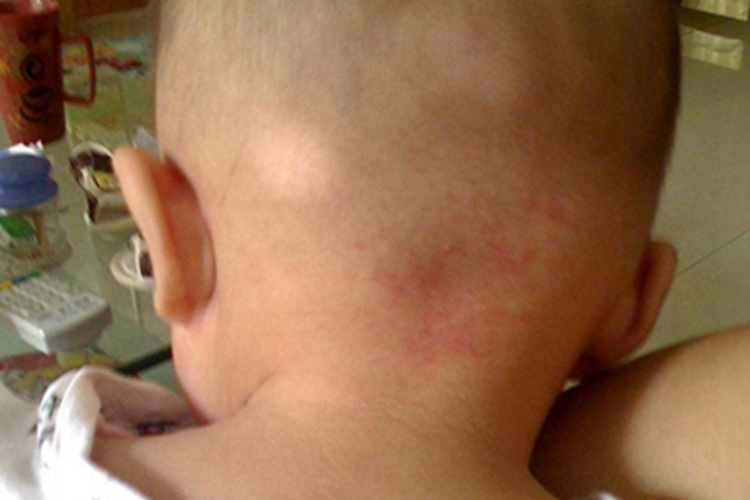 未定类型白癜风头皮白斑图