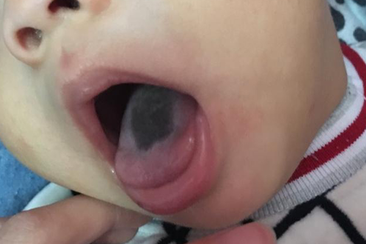 食物染色舌苔发黑图 食物染色舌苔发黑图