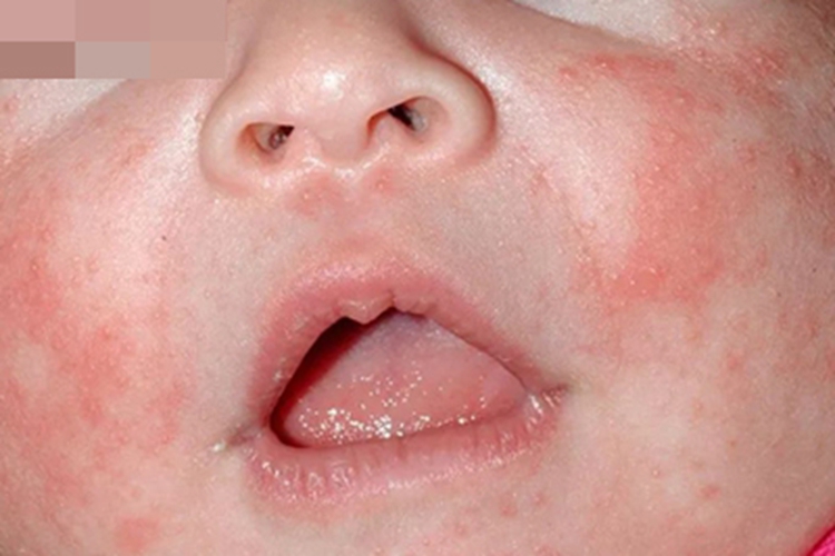 新生儿痤疮面部丘疹图