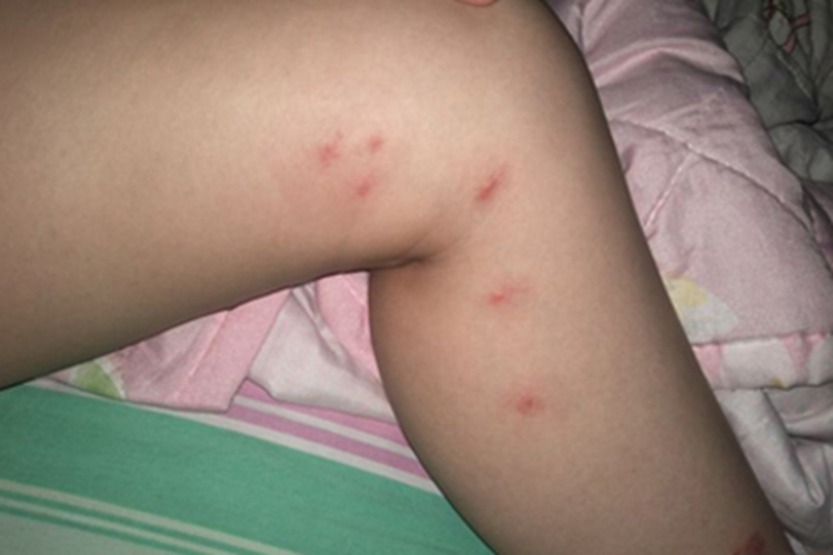 虫咬皮炎腿小红疙瘩图