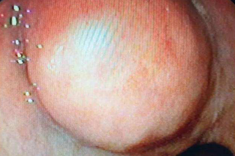 胃囊肿内镜检查影像图