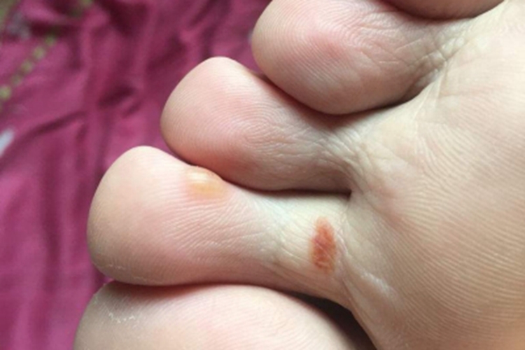 脚趾长水疱颜色为黄色图