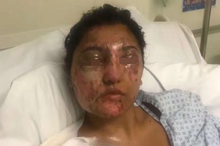 硫酸烧伤图 硫酸烧伤图