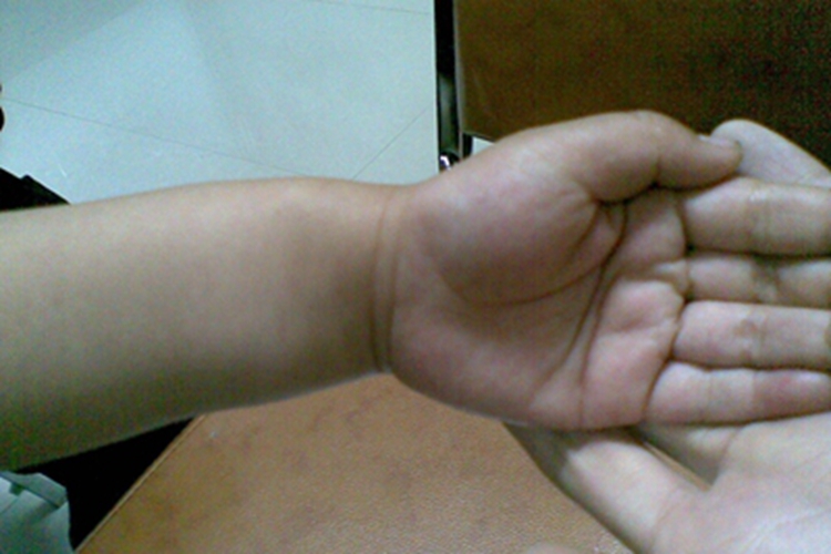 单发性骨软骨瘤手腕症状图