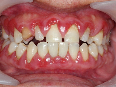 牙龈萎缩牙龈红肿溃疡烂了图.jpg