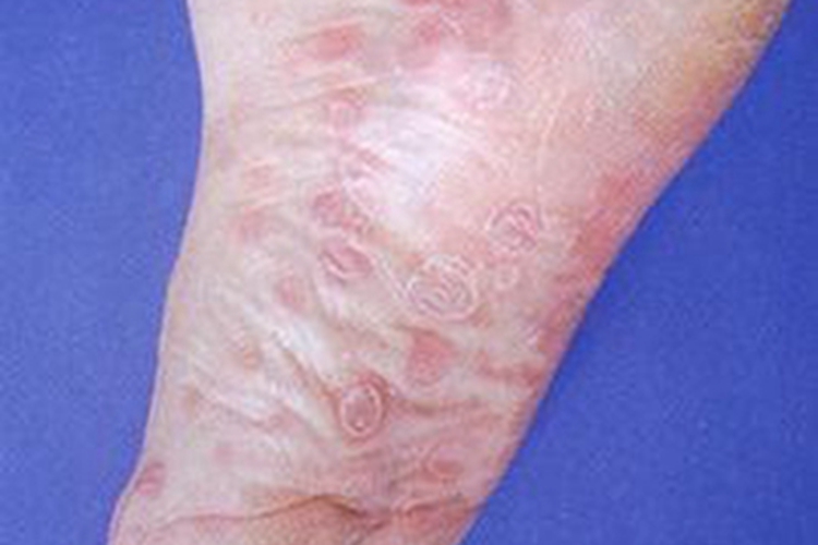 斑疹性梅毒疹脚底红斑图