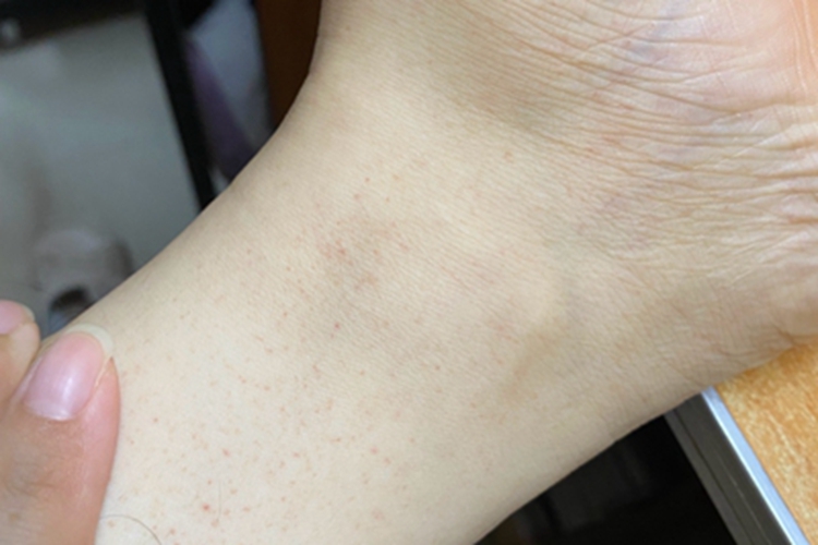 皮下出血小腿瘀点图