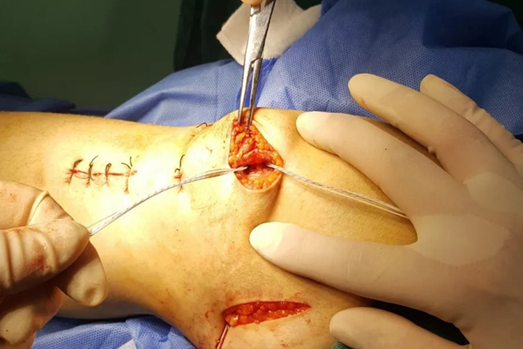 髌骨脱位手术髌骨骨道操作图