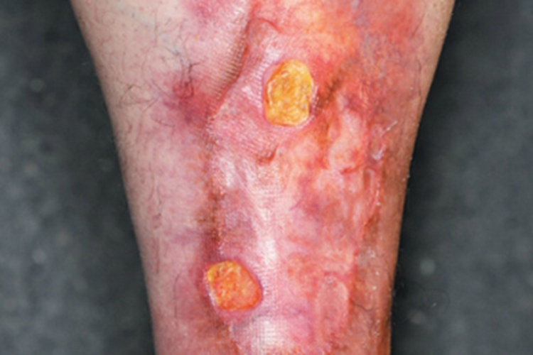 类脂质渐进性坏死皮肤溃疡图