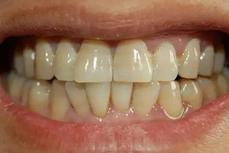 轻度四环素着色图 轻度四环素着色图