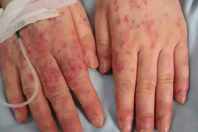 手背结节性血管炎图