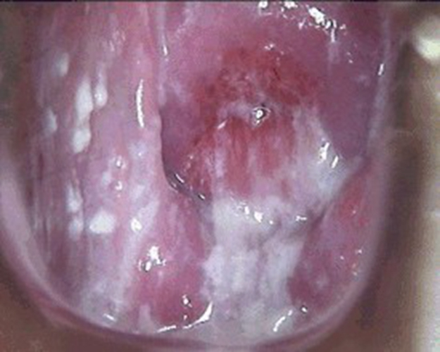 外阴阴道假丝酵母菌病图