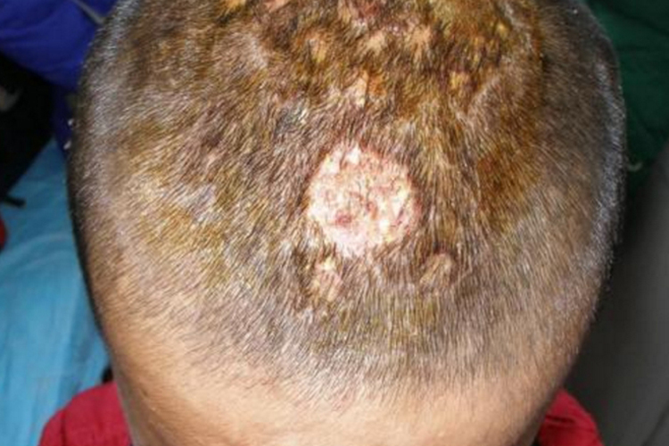 小孩头癣图 小孩头癣图