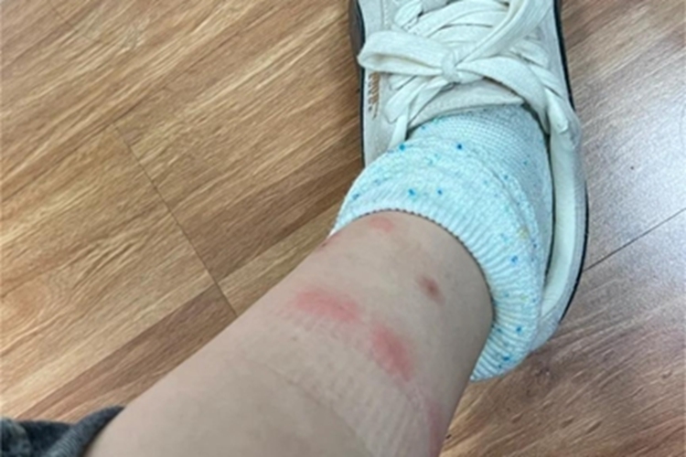 蚊虫叮咬小腿红斑图