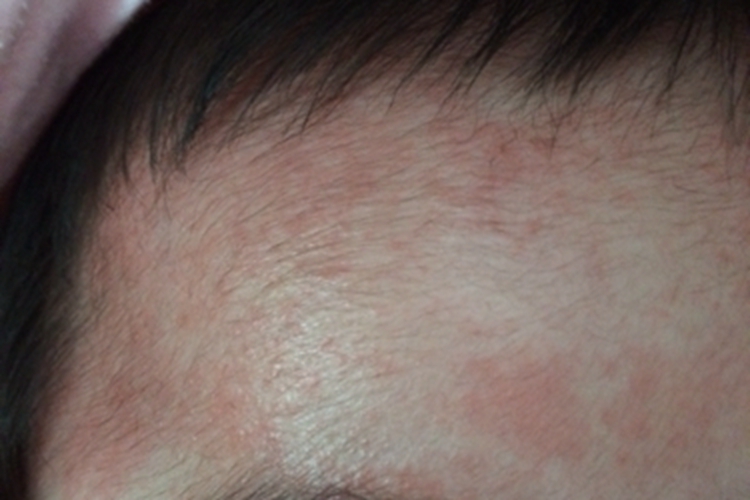 上眼皮湿疹图 上眼皮湿疹图