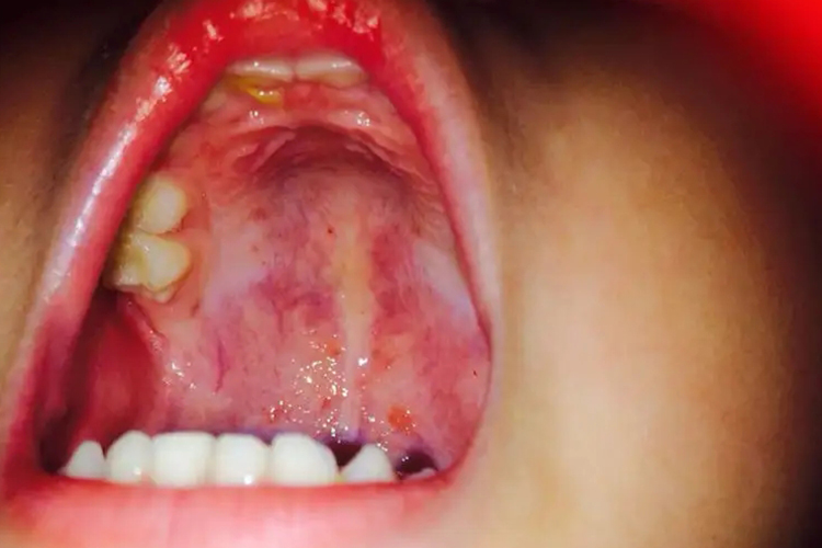 复发性阿弗他溃疡图 复发性阿弗他溃疡图