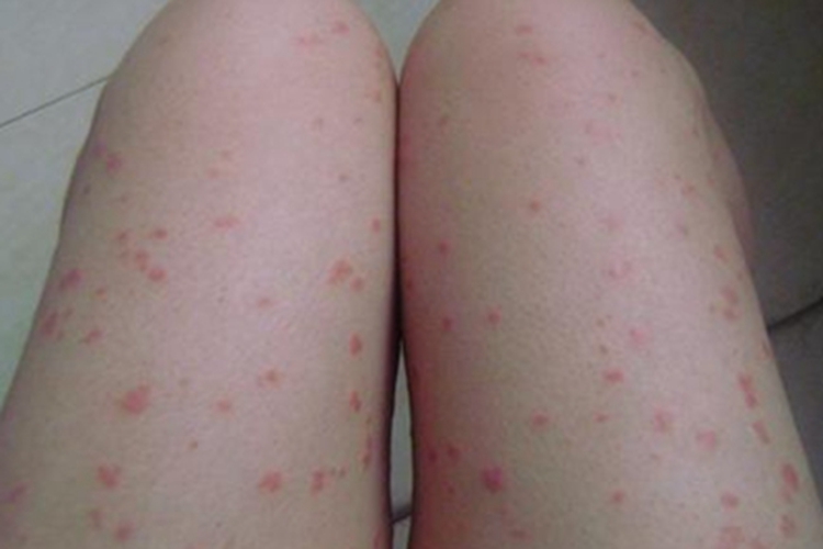 儿童银屑病丘疹图 儿童银屑病丘疹图