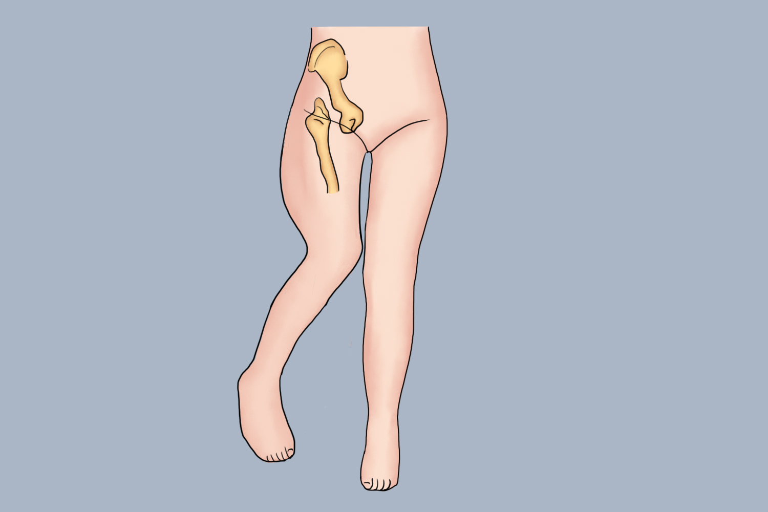 髋关节后脱位典型体征图