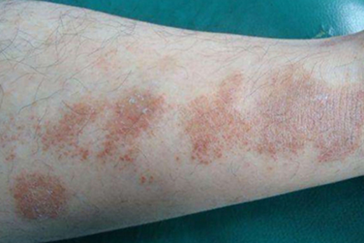 血管萎缩性皮肤异色病小腿红斑图 血管萎缩性皮肤异色病小腿红斑图