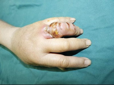 海鱼分枝杆菌感染手指肿胀化脓图.jpeg