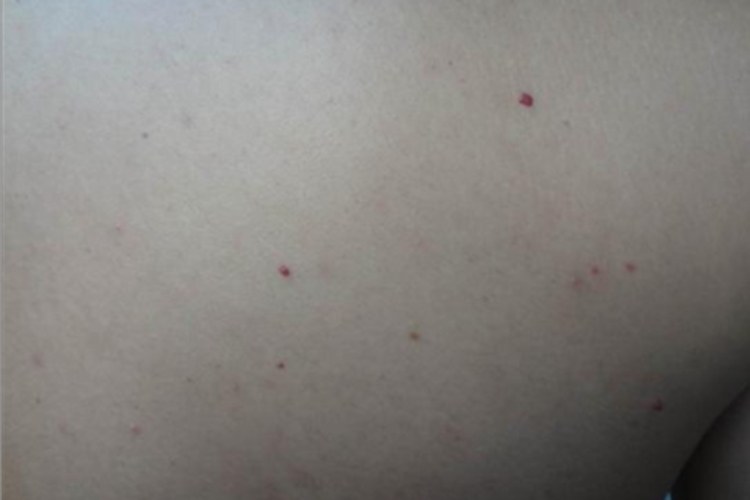 樱桃状血管瘤后背红点图