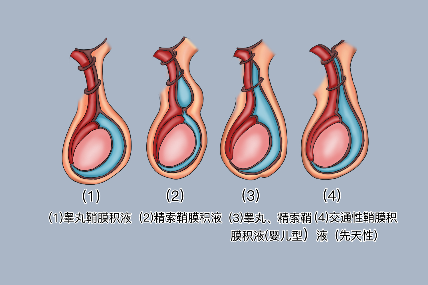 满月宝宝睾丸积液图片图片