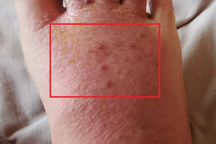 渗出型婴儿湿疹脚背红点图