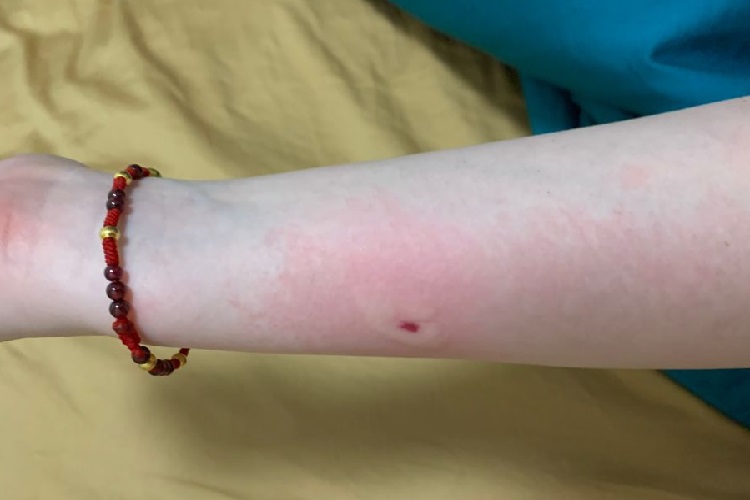 蜂蛰伤胳膊疙瘩图 蜂蛰伤胳膊疙瘩图