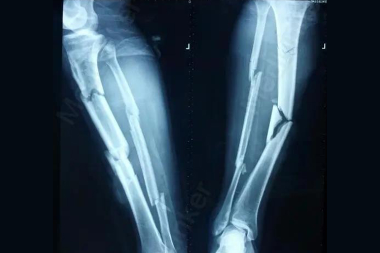 小腿粉碎性骨折影像图 小腿粉碎性骨折影像图