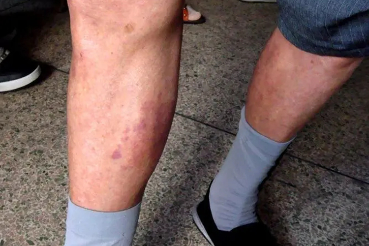 淤积性皮炎小腿紫块图