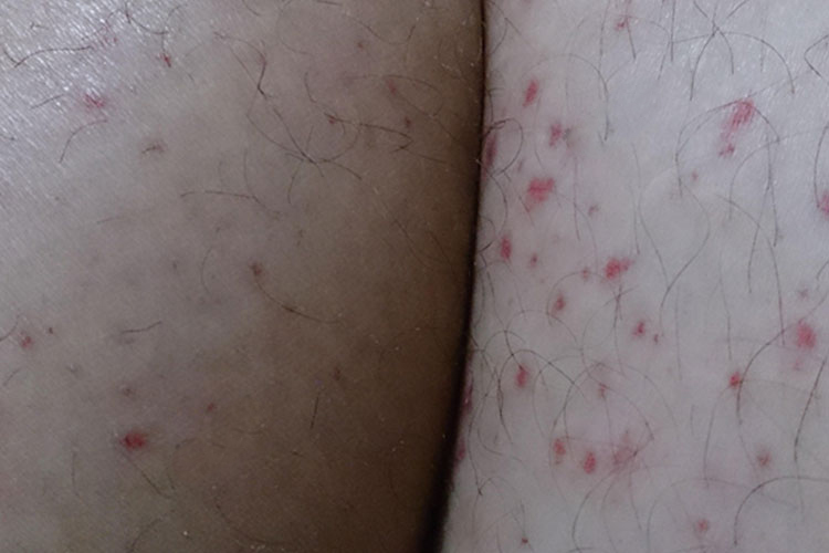 腿部急性HIV皮疹图