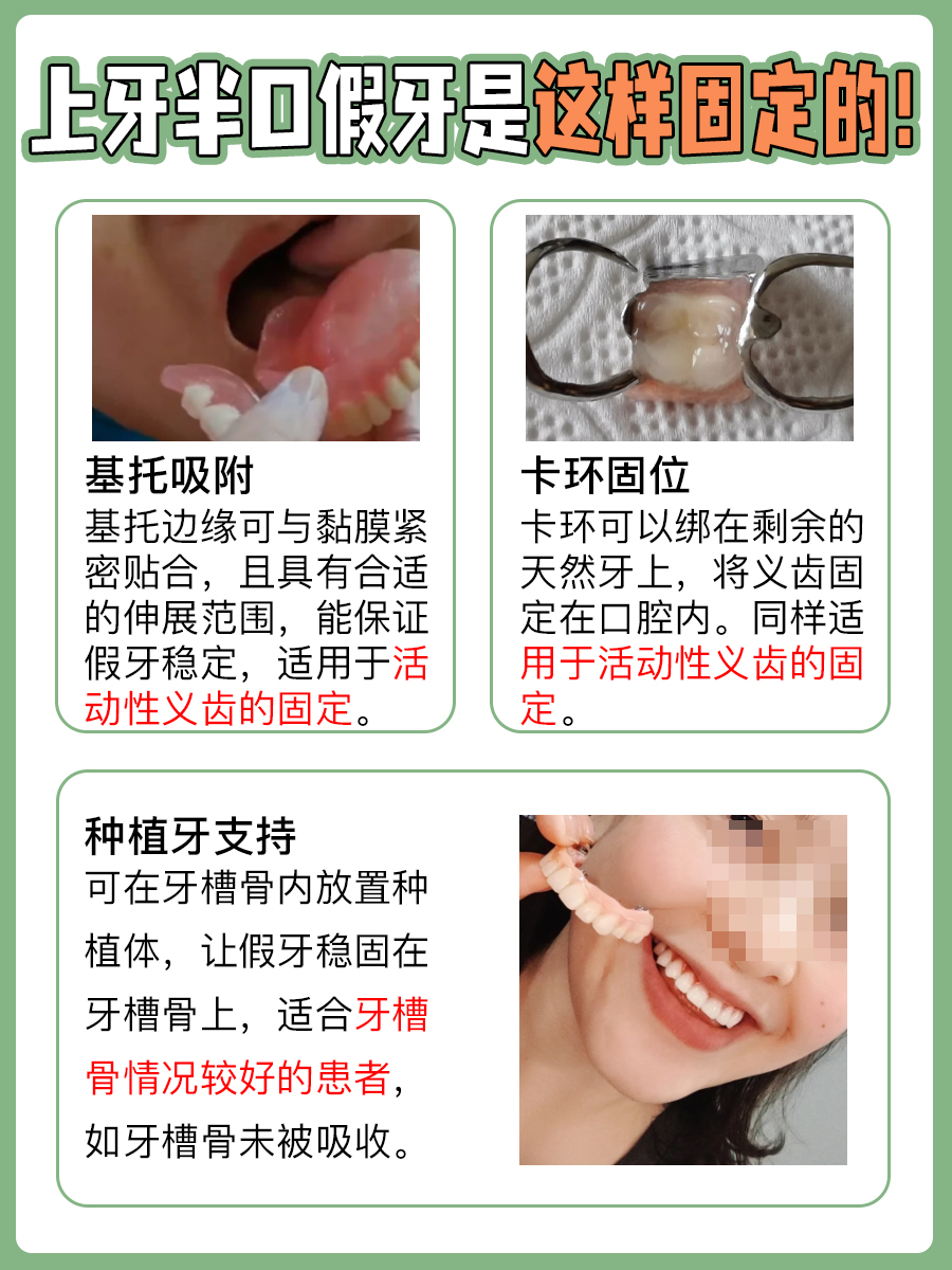 上牙半口假牙固定,门道在此!