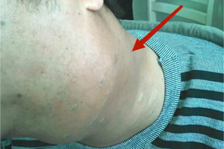 皮肤非典型分枝杆菌病肿块图 皮肤非典型分枝杆菌病肿块图